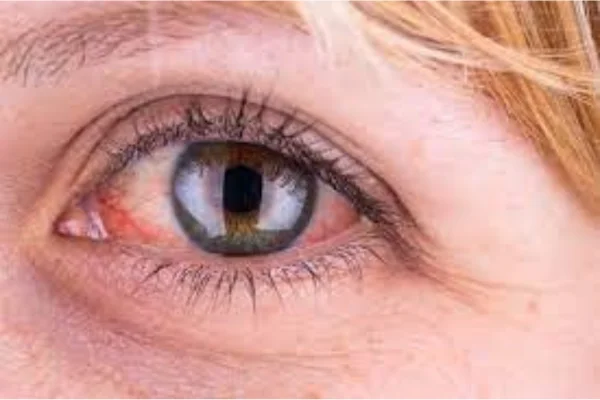 Does Pink Eye Go Away On Its Own